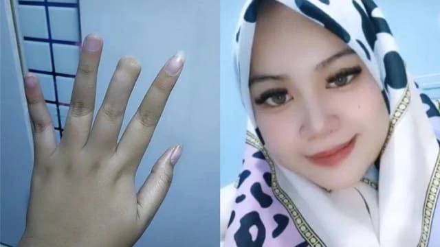 父母三天沒脫嬰兒手套 馬國女子從小斷指