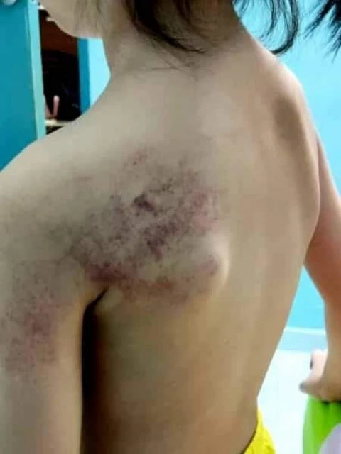 疑不滿女學生常做錯功課   華裔女老師抽打女童至瘀傷