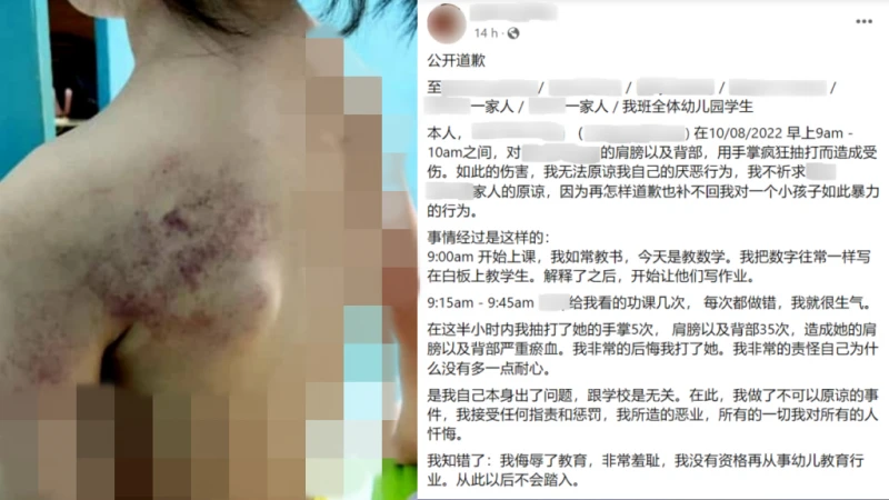 抽打女童至淤傷 幼教老師社媒公開道歉