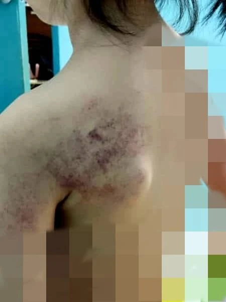 抽打女童至淤傷 幼教老師社媒公開道歉