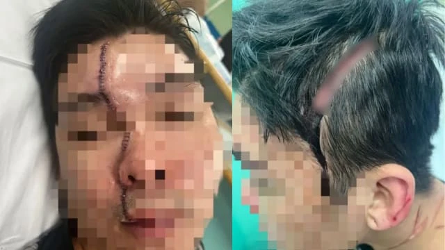 鄰居糾紛變嚴重砍人案 馬國男子縫120針毀容