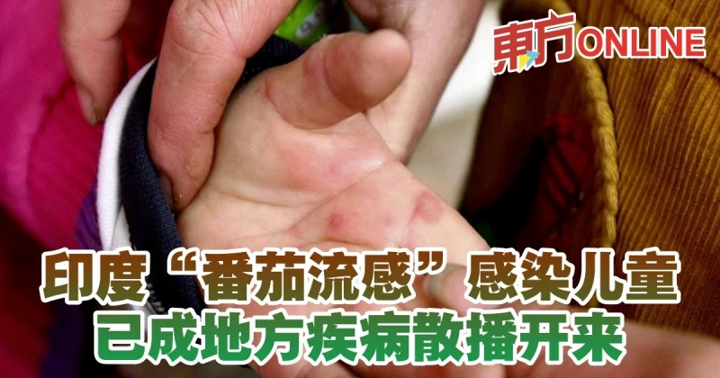 印度「番茄流感」感染兒童　已成地方疾病散播開來