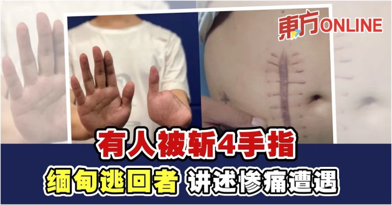 緬甸逃回者講述慘痛遭遇　有男子被斬4手指