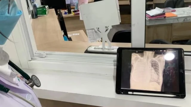 吸入丈夫二手菸20多年 妻患癌「肺部一半消失」