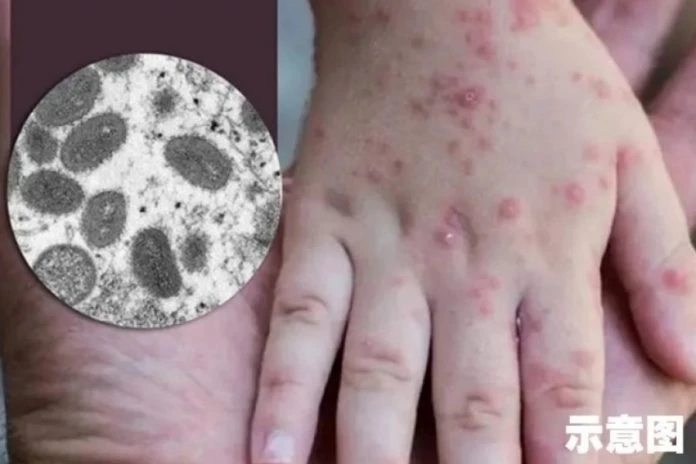 泰國再通報猴痘病例　大馬人遊玩泰國需小心