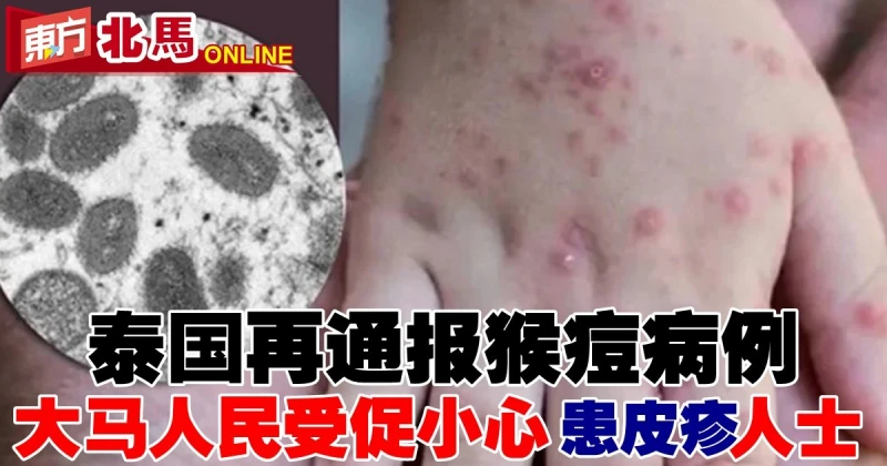 泰國再通報猴痘病例　大馬游泰人民受促小心患皮疹人士