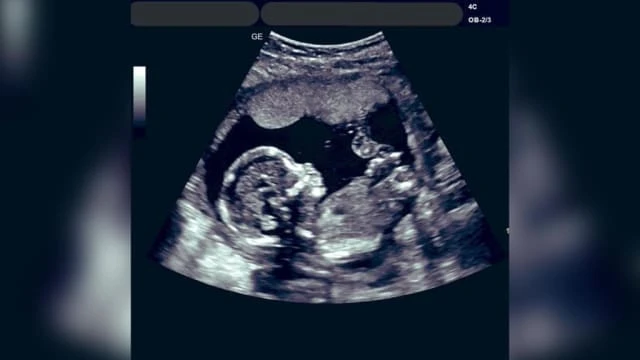 丈夫責備生不出感壓力 馬國妻找他人結珠胎證能孕