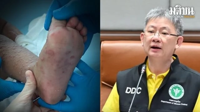 「番茄流感」傳播率引憂 泰疾控廳密切關注