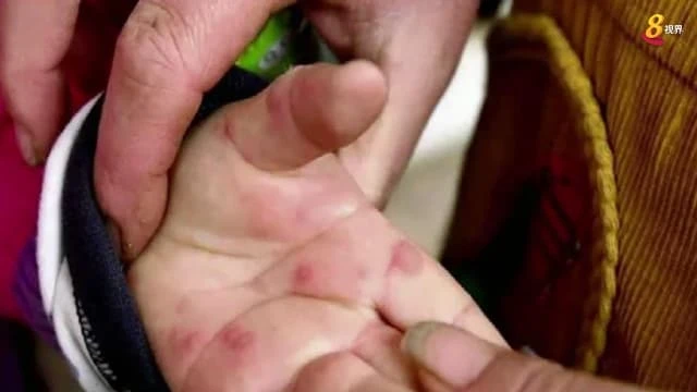 「番茄流感」傳播率引憂 泰疾控廳密切關注