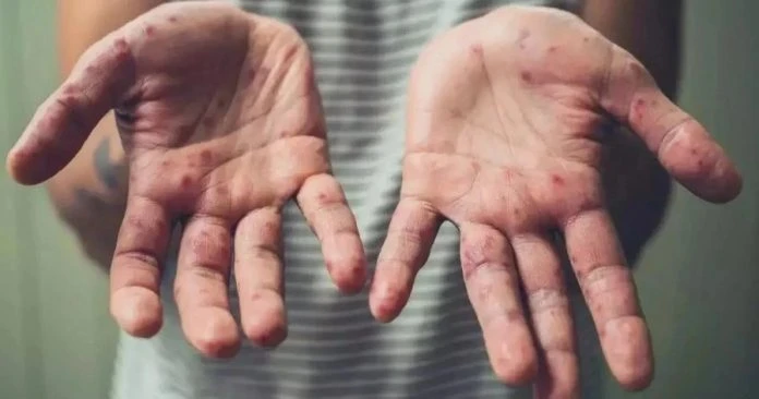 新冠疫情剛受控制　大馬或面對猴痘威脅