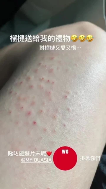 黃翠如游大馬慘被榴槤高處滾落擲中　白滑美腿驚現20個洞洞