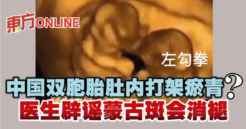 中國雙胞胎肚內打架瘀青？　醫生闢謠蒙古斑會消褪