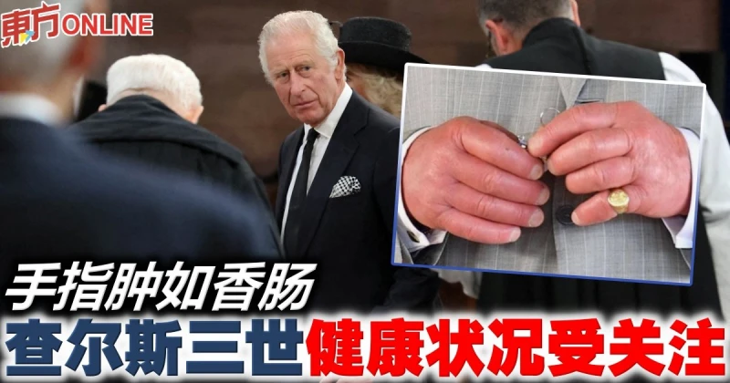 手指腫如香腸　查爾斯三世健康狀況受關注
