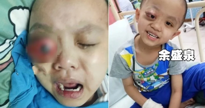 全馬首宗眼球腫大  6歲華裔男童需35萬治療