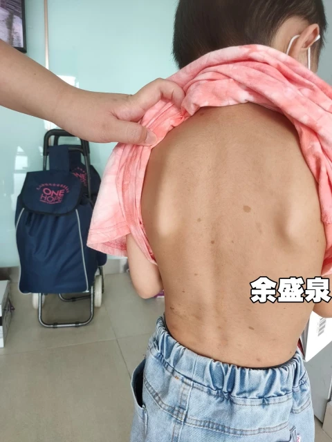 全馬首宗眼球腫大  6歲華裔男童需35萬治療