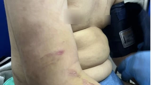 馬國男童長期穿外套上學 老師一查驚見一身傷