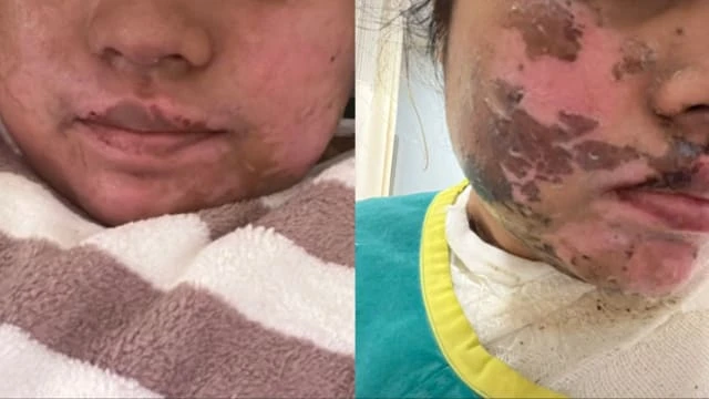 氣壓鍋突然炸開 馬國女子滾湯著身嚴重灼傷