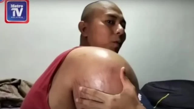 醫生誤判骨肉瘤為肩周炎 馬國男子三角肌腫大如球