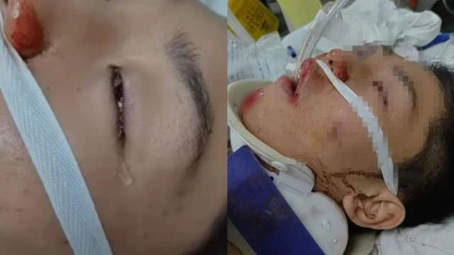 馬國少年騎摩托誤撞井蓋腦積血 聞母呼喚昏迷中也掉淚