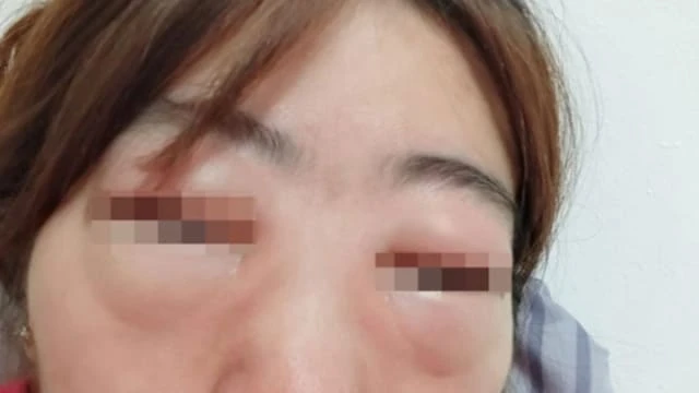 馬國女子亂吃藥 導致臉部嚴重腫脹
