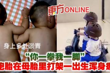 「你一拳我一腳」　雙胞胎在母胎里打架一出生渾身瘀青