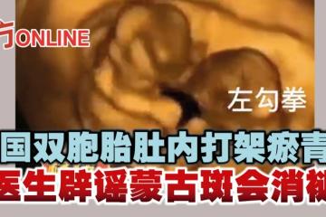 中國雙胞胎肚內打架瘀青？　醫生闢謠蒙古斑會消褪