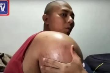 醫生誤判骨肉瘤為肩周炎 馬國男子三角肌腫大如球