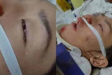 馬國少年騎摩托誤撞井蓋腦積血 聞母呼喚昏迷中也掉淚