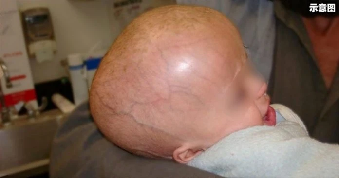 請停止對腦積水患者及家庭的嘲笑侮辱