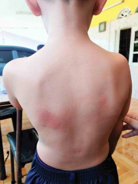 一年級學生上課睡著未完成功課　遭老師掌摑鐵尺打背母親要報案