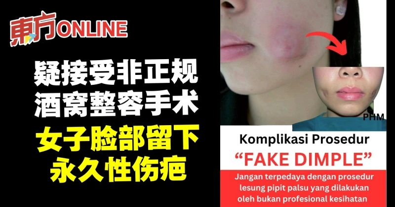 疑接受非正規酒窩整容手術　女子臉部留下永久性傷疤