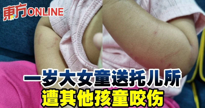 一歲大女童送託兒所　遭其他孩童咬傷