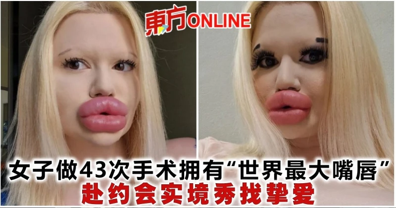 女子做43次手術擁有「世界最大嘴唇」　赴約會實境秀找摯愛