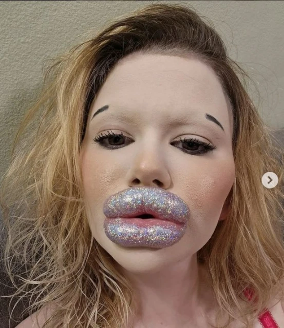 女子做43次手術擁有「世界最大嘴唇」　赴約會實境秀找摯愛