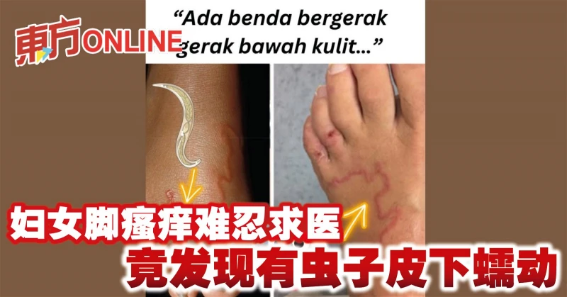 婦女腳瘙癢難忍求醫　竟發現有蟲子皮下蠕動