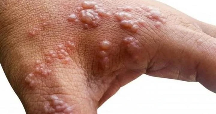 大馬境內首現猴痘病例　衛生部：2患者曾有接觸