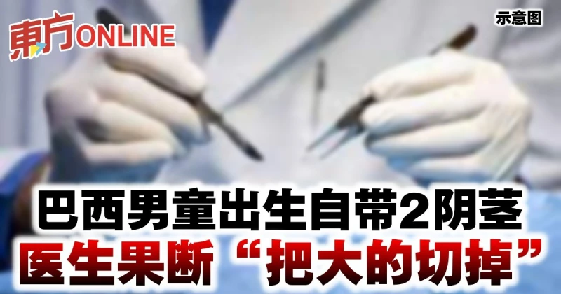 巴西男童出生自帶2陰莖　醫生果斷「把大的切掉」