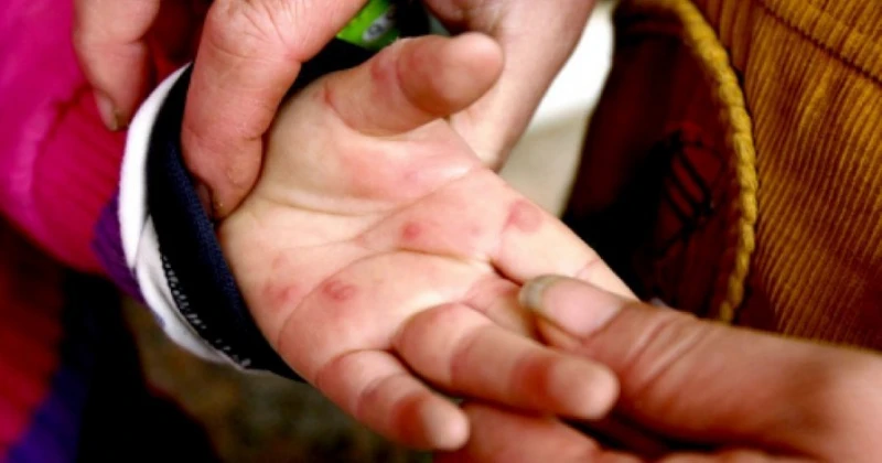 雪州手足口症大爆發 病例數已超過警戒線