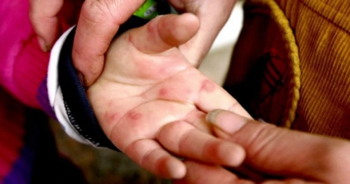 雪州手足口症大爆發 病例數已超過警戒線