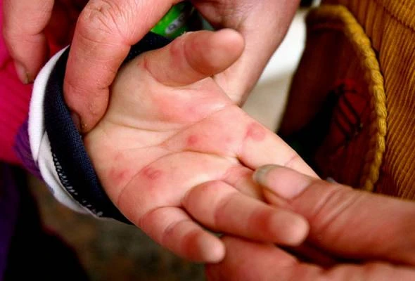 手足口症累積5346宗  雪衛生局長：已越警戒線