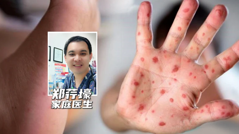 疫情未消退  手足口症來襲  幼童暴露雙重風險