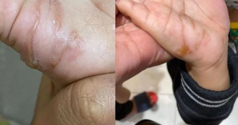 玩泥沙後全身癢睡不著 男童慘遭幼蟲「鑽入掌心」