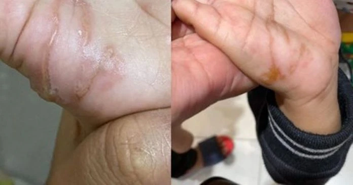 玩泥沙後全身癢睡不著 男童慘遭幼蟲「鑽入掌心」