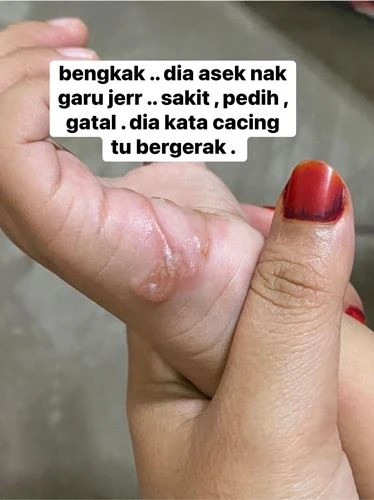 玩泥沙後全身癢睡不著   男童慘遭幼蟲「鑽入掌心」