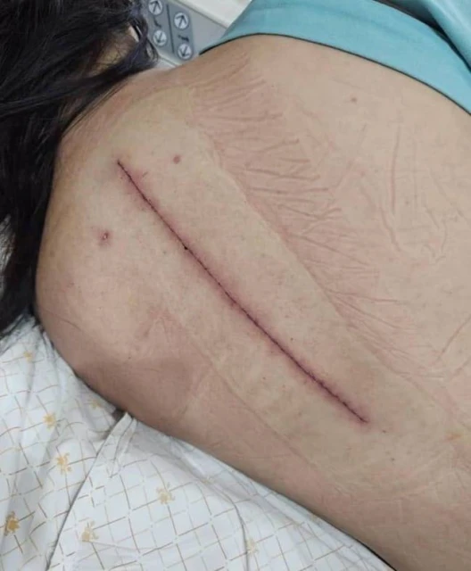 【新航SQ321事故】為保護胎兒拒服止痛藥　受傷大馬孕婦痛不能寐